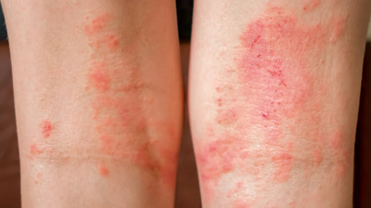 Dermatitis: Recognizing the Signs and Symptoms
