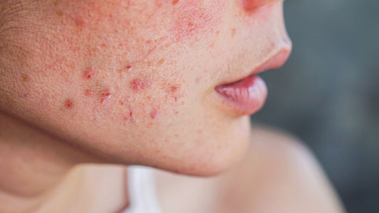 Acne: Signs, Symptoms, and Effective Treatments