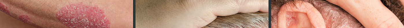 Psoriasis: Recognizing Signs and Symptoms