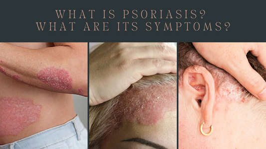 Psoriasis: Recognizing Signs and Symptoms