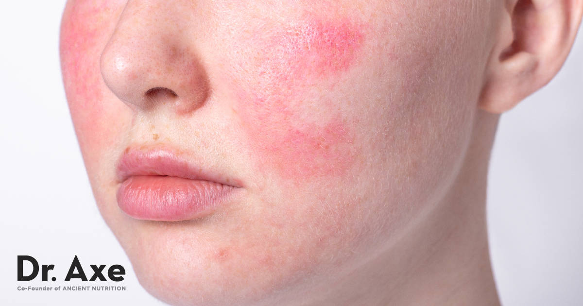 Rosacea